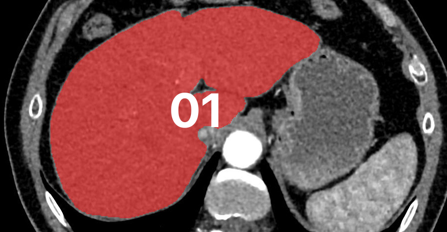 Introduction to deep learning liver segmentation using U-Net, MONAI, and PyTorch for medical imaging.