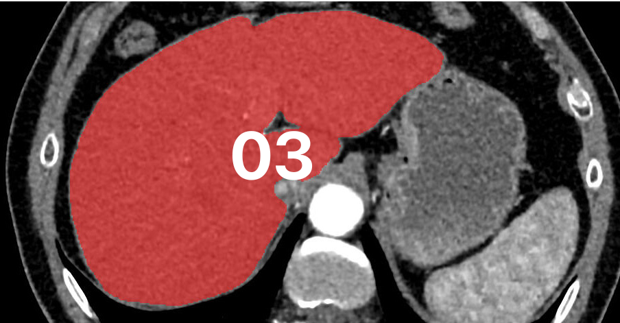 Common errors in MONAI for medical imaging: troubleshooting data paths, dictionary keys, and segmentation labels.