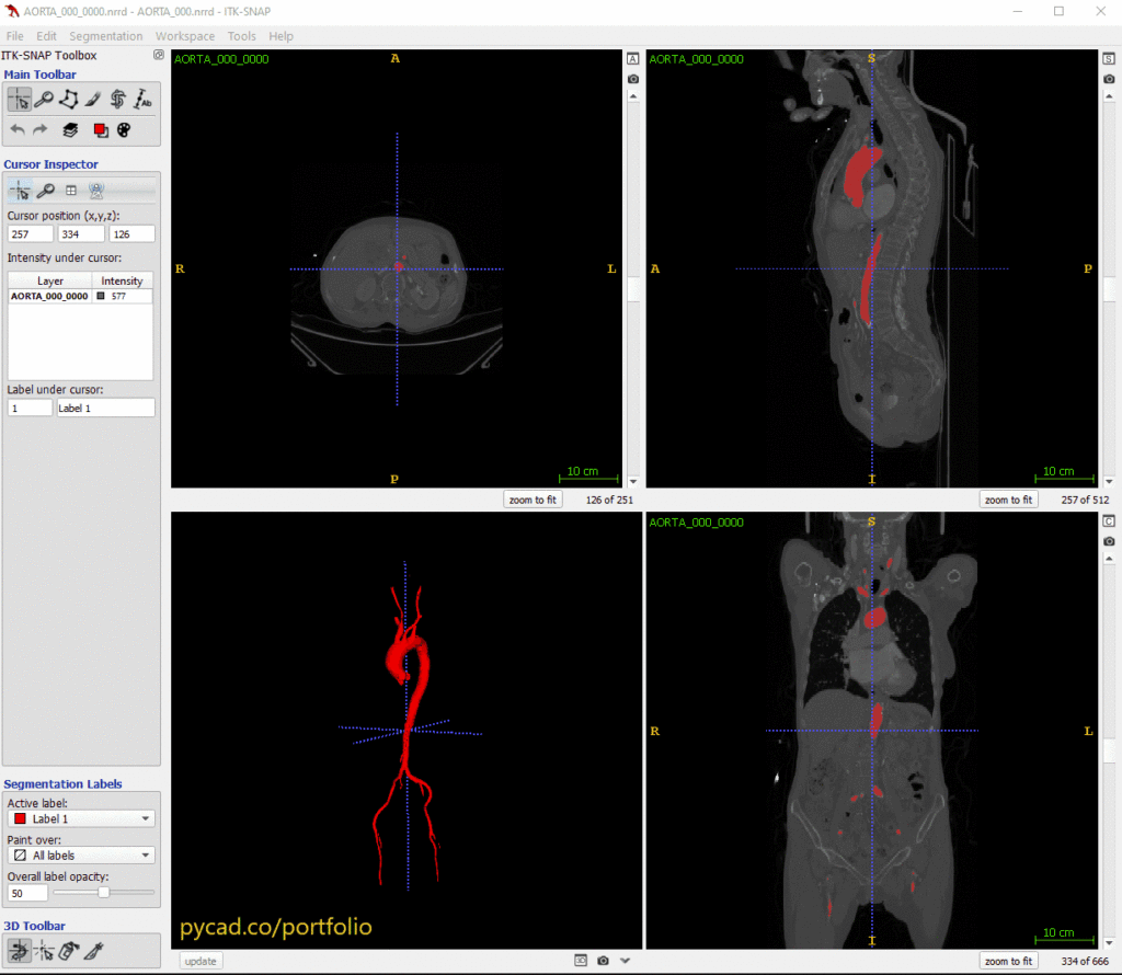 Output of nnUNet model for segmenting the aorta in full body CT scans.