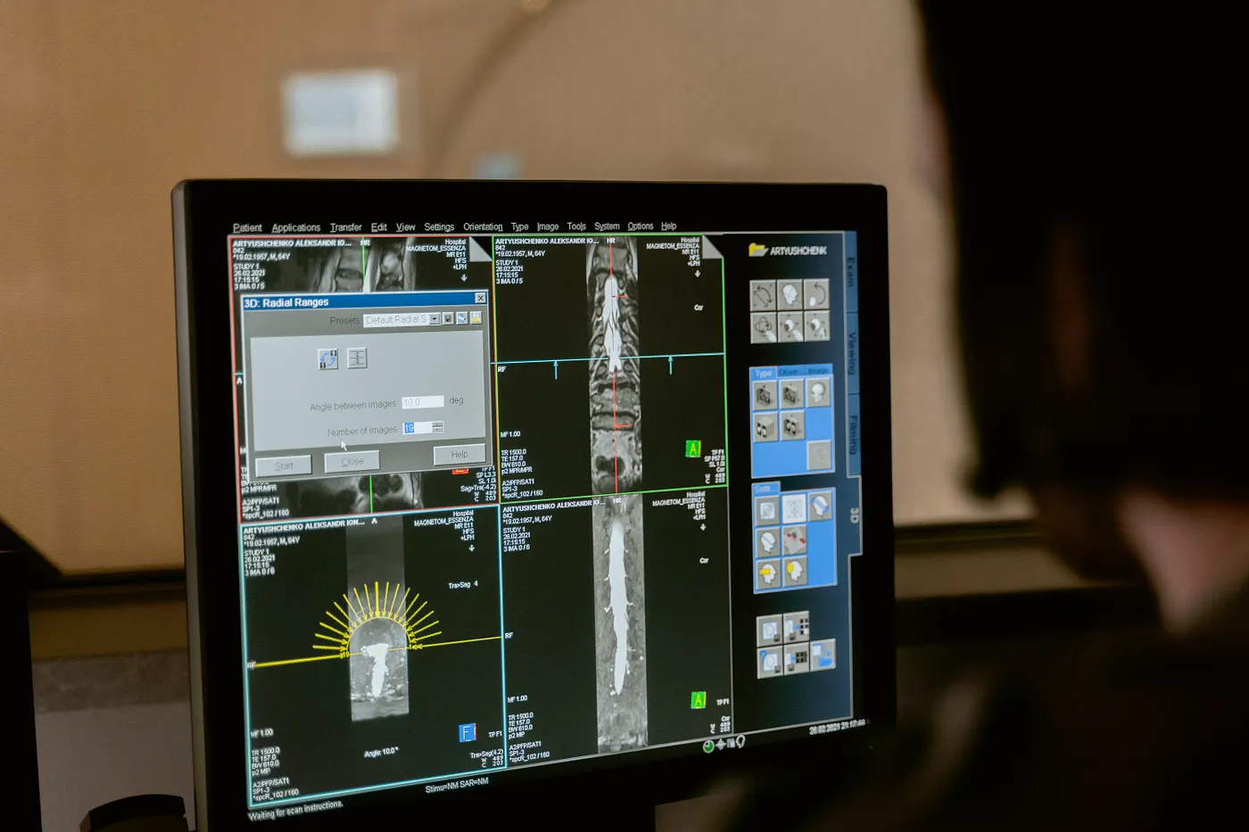 3D tumor segmentation data augmentation using MONAI: techniques for deep learning in medical imaging.