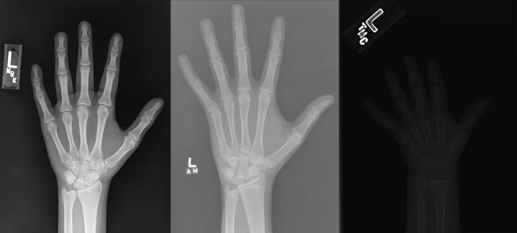 CNNs vs Vision Transformers for medical imaging: AI model comparison on bone fracture and age detection using X-rays.