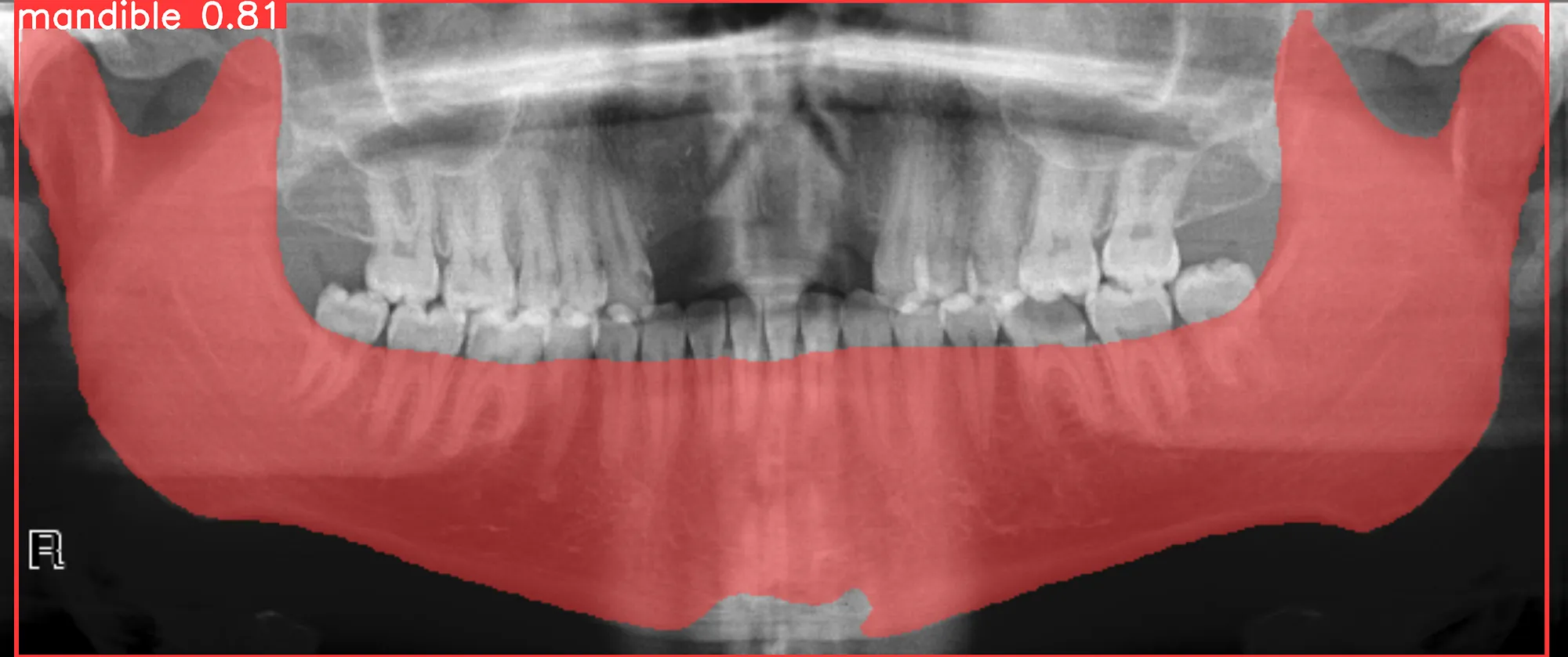 Mandible segmentation using YOLOv8 model on panoramic X-ray images with PYCAD library for dataset preparation and training.