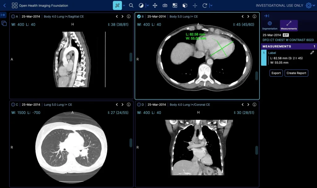 Simplifying medical imaging with OHIF web-based DICOM viewer for accessible healthcare solutions