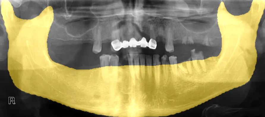 Panoramic X-ray with segmented mandible highlighted, demonstrating the inference results of a trained YOLOv8 model for mandible segmentation using the PYCAD library.