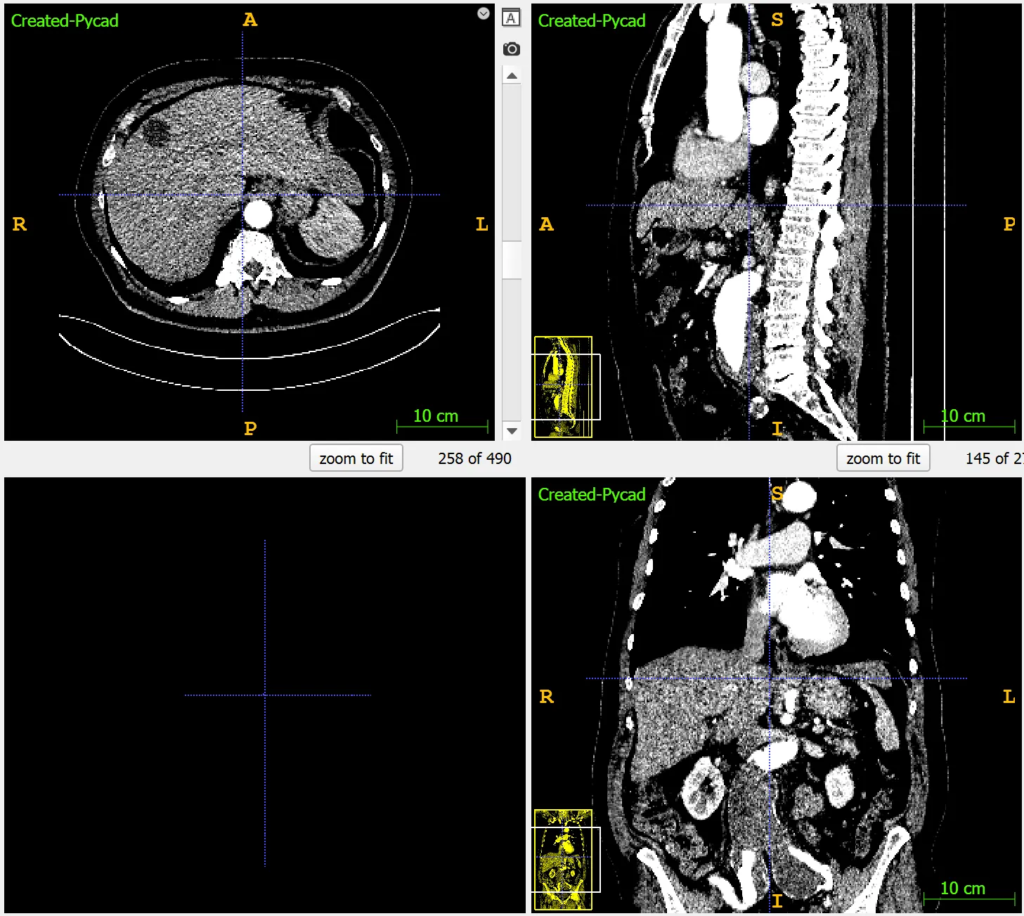 CT scan of liver with Window Center +60 HU and Window Width 150 HU for enhanced liver texture visualization and abnormality detection