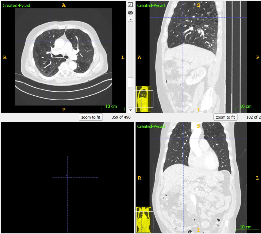 CT scan of lungs with Window Center -600 to -700 HU and Window Width 1500 to 2000 HU highlighting lung tissues for nodule and infection detection