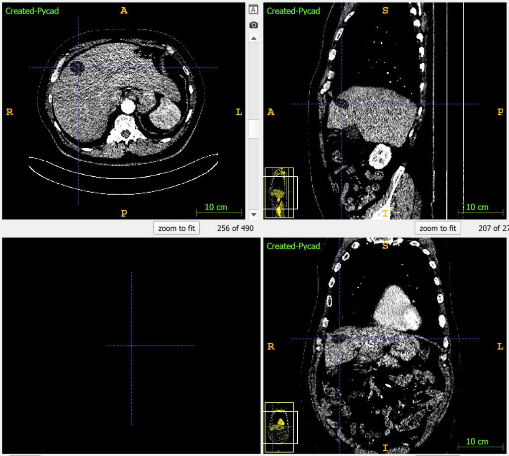 CT scan with adjusted Window Center and Window Width settings to enhance tumor detection and tissue contrast for better diagnosis