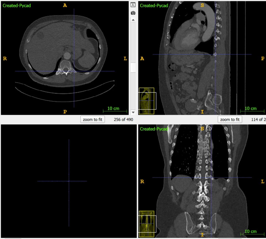 CT scan optimized with high Window Center and Window Width settings for enhanced bone visibility, highlighting fractures and lesions