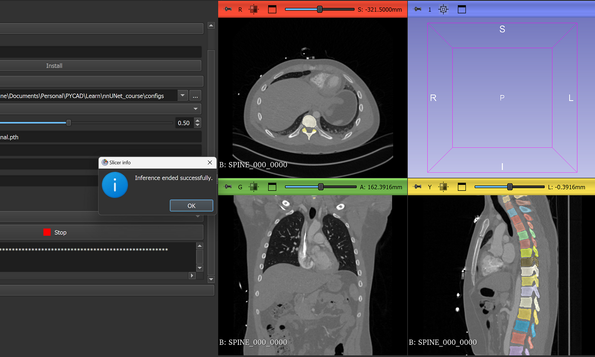 nnUNet model spine segmentation results in 3D Slicer with successful inference message