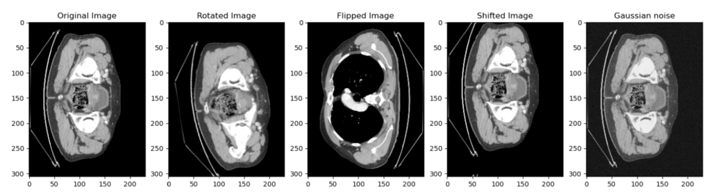 3D tumor segmentation data augmentation using MONAI: techniques for deep learning in medical imaging.