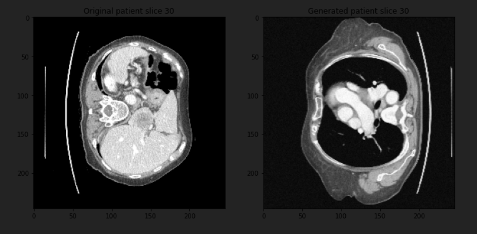 3D tumor segmentation data augmentation using MONAI: techniques for deep learning in medical imaging.