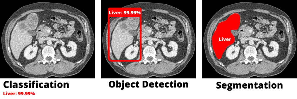 Introduction to deep learning liver segmentation using U-Net, MONAI, and PyTorch for medical imaging.