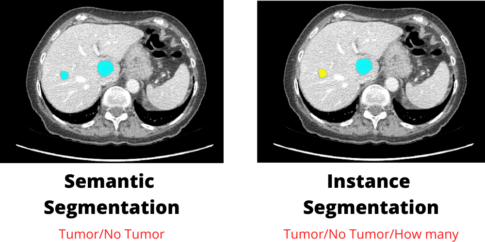 Introduction to deep learning liver segmentation using U-Net, MONAI, and PyTorch for medical imaging.