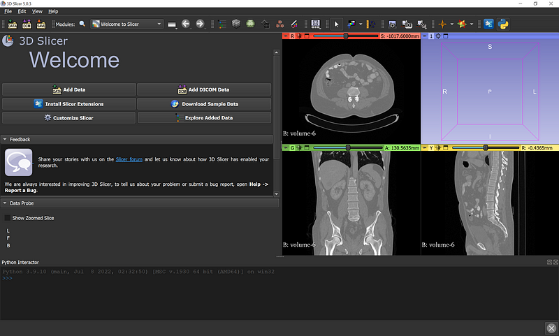 3D Slicer interface displaying a medical scan with axial, sagittal, and coronal views, highlighting the software’s multi-axis visualization capabilities for medical imaging.