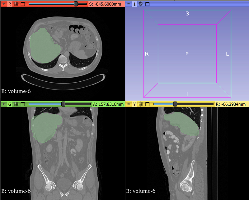 3D Slicer Free software for visualizing, editing, and segmenting medical images in DICOM and NIfTI formats using 3D Slicer and ITK-Snap tools.