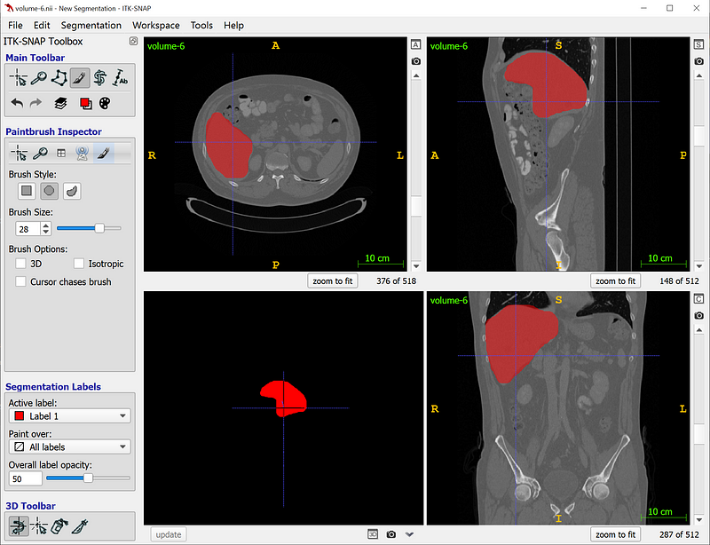 ITK-SNAP segmentation tool showing 3D visualization of medical scans in axial, sagittal, and coronal views.