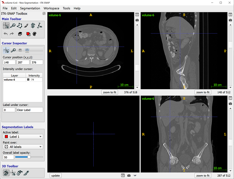 ITK-SNAP interface for visualizing DICOM and NIfTI medical imaging files.