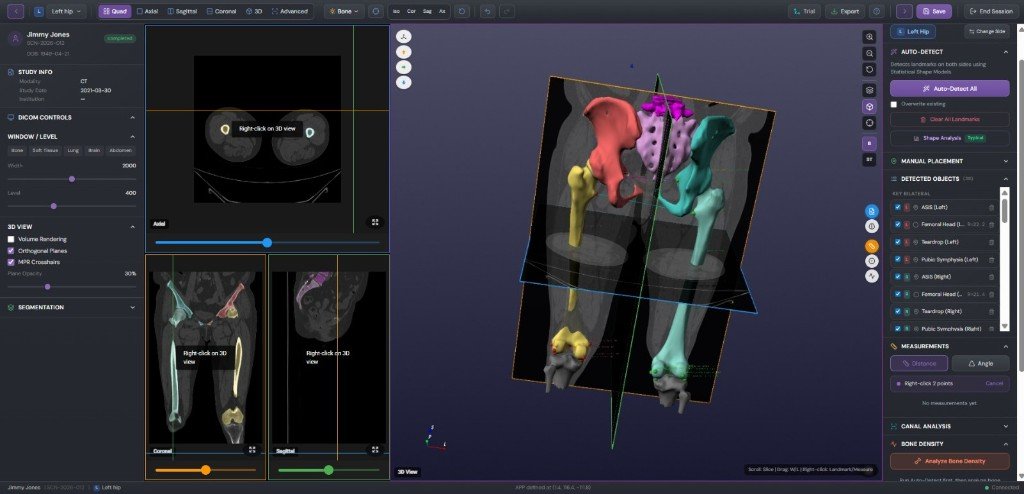 Custom DICOM viewer with 3D hip and pelvis segmentation for orthopedic implant planning