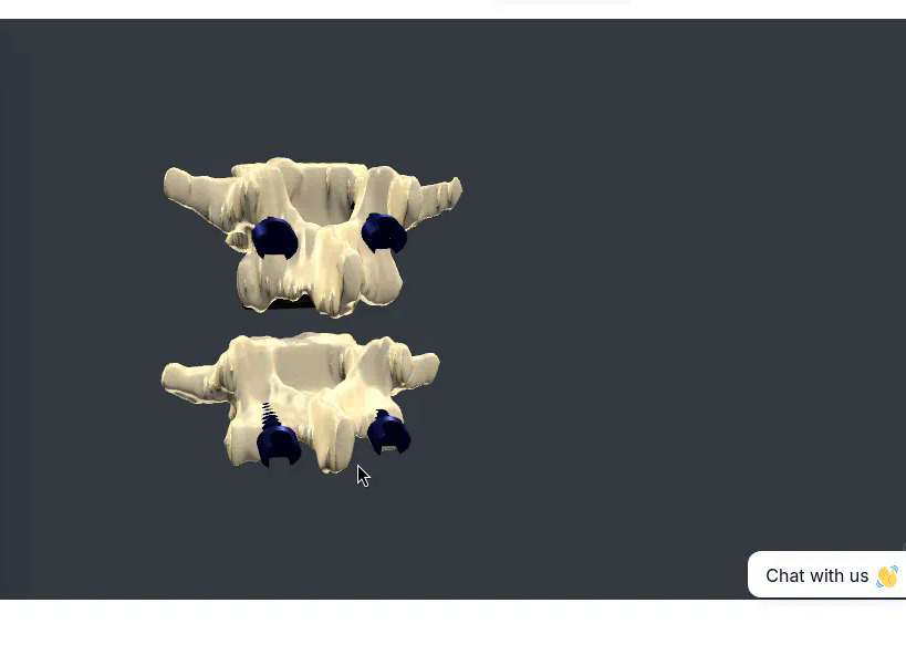 Closer look at the L4–L5 cage and pedicle screw construct in the interactive demo.