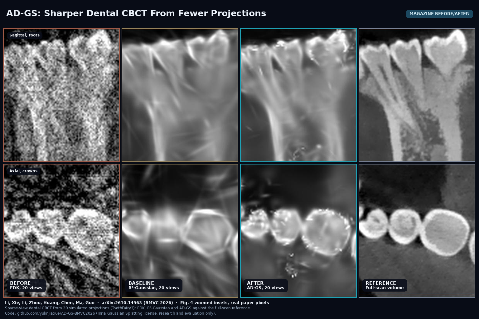 Magazine before/after from Fig. 4: zoomed sagittal roots and axial crowns of a dental CBCT reconstructed from 20 projections with FDK, R2-Gaussian and AD-GS, beside the full-scan reference. Li, Xie et al., arXiv:2610.14963