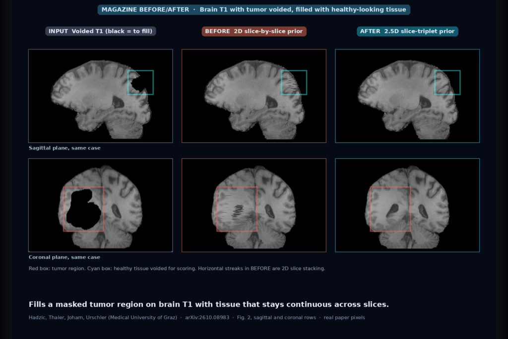 Sagittal and coronal brain T1 slices with a tumor region and a healthy test region blacked out, the 2D baseline fill showing horizontal slice streaks, and the 2.5D fill continuous across slices (Hadzic et al., arXiv:2610.08983, Fig. 2)