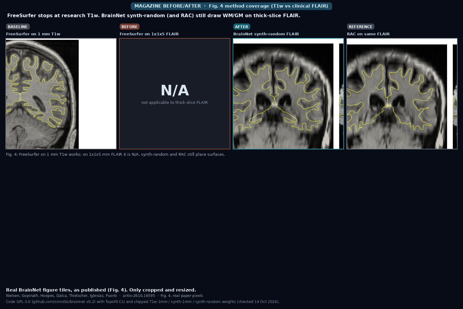 Four coronal panels from Fig. 4: FreeSurfer WM/GM on 1 mm T1w, FreeSurfer N/A on 1x1x5 mm FLAIR, BrainNet synth-random surfaces on the same FLAIR, and RAC on that FLAIR (Nielsen et al., arXiv:2610.16595)