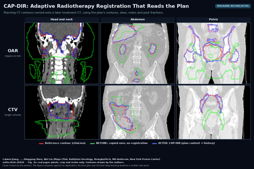 Magazine before/after grid from Fig. 3e: coronal treatment CT slices of the head and neck, abdomen and pelvis, with organ-at-risk contours in the top row and target-volume contours in the bottom row. Red is the clinician reference, green is the planning contour copied over without registration, blue is the CAP-DIR propagated contour. Caiwen Jiang, ..., Dinggang Shen, Wei Liu, Mayo Clinic, arXiv:2610.18926