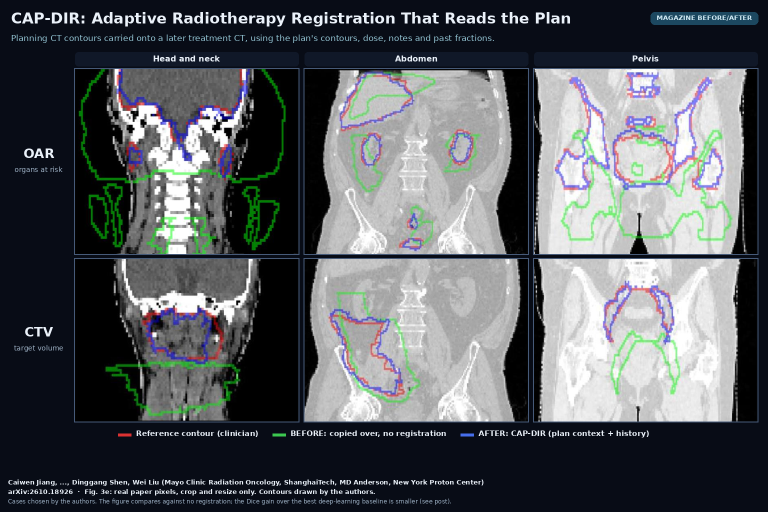 Magazine before/after grid from Fig. 3e: coronal treatment CT slices of the head and neck, abdomen and pelvis, with organ-at-risk contours in the top row and target-volume contours in the bottom row. Red is the clinician reference, green is the planning contour copied over without registration, blue is the CAP-DIR propagated contour. Caiwen Jiang, ..., Dinggang Shen, Wei Liu, Mayo Clinic, arXiv:2610.18926