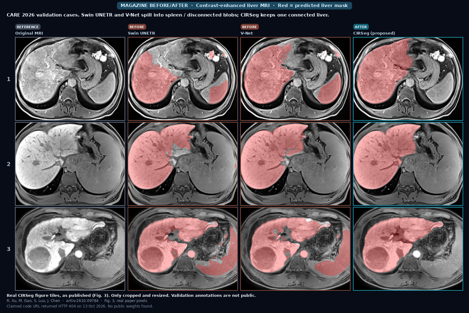Three CARE 2026 contrast-enhanced liver MRI validation cases with red liver overlays from Swin UNETR and V-Net showing spleen spill and disconnected blobs, beside clean CIRSeg masks and the original images (Xu, Gao, Luo, Chen, arXiv:2610.09784, Fig. 3)