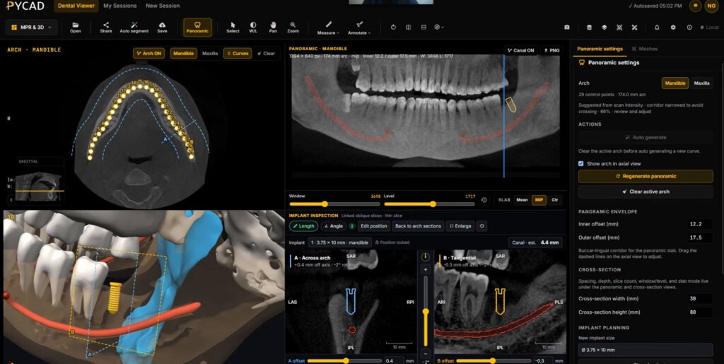 PYCAD Dental Viewer with an axial slice, a panoramic with the mandibular canal in red, a 3D view of an implant near the canal and airway, and implant cross-sections