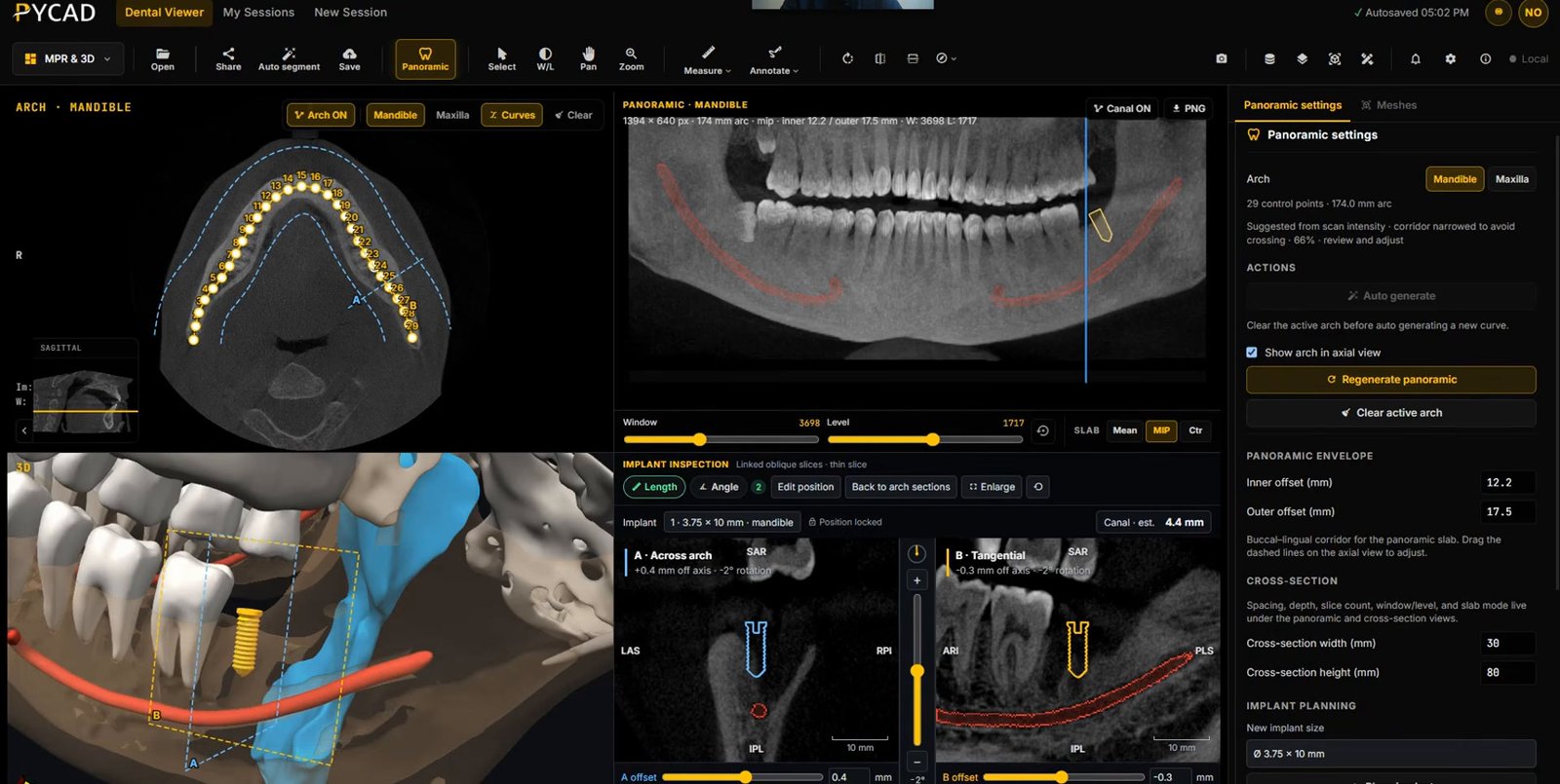 PYCAD Dental Viewer with an axial slice, a panoramic with the mandibular canal in red, a 3D view of an implant near the canal and airway, and implant cross-sections