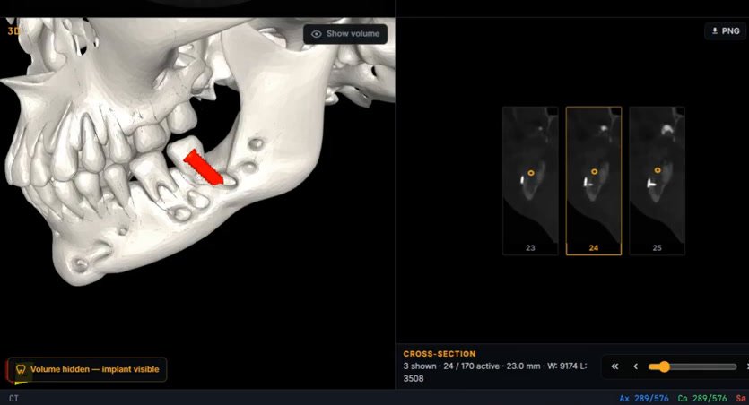 3D jaw with a placed implant in red, next to cross-sections 23, 24 and 25 with the implant position marked