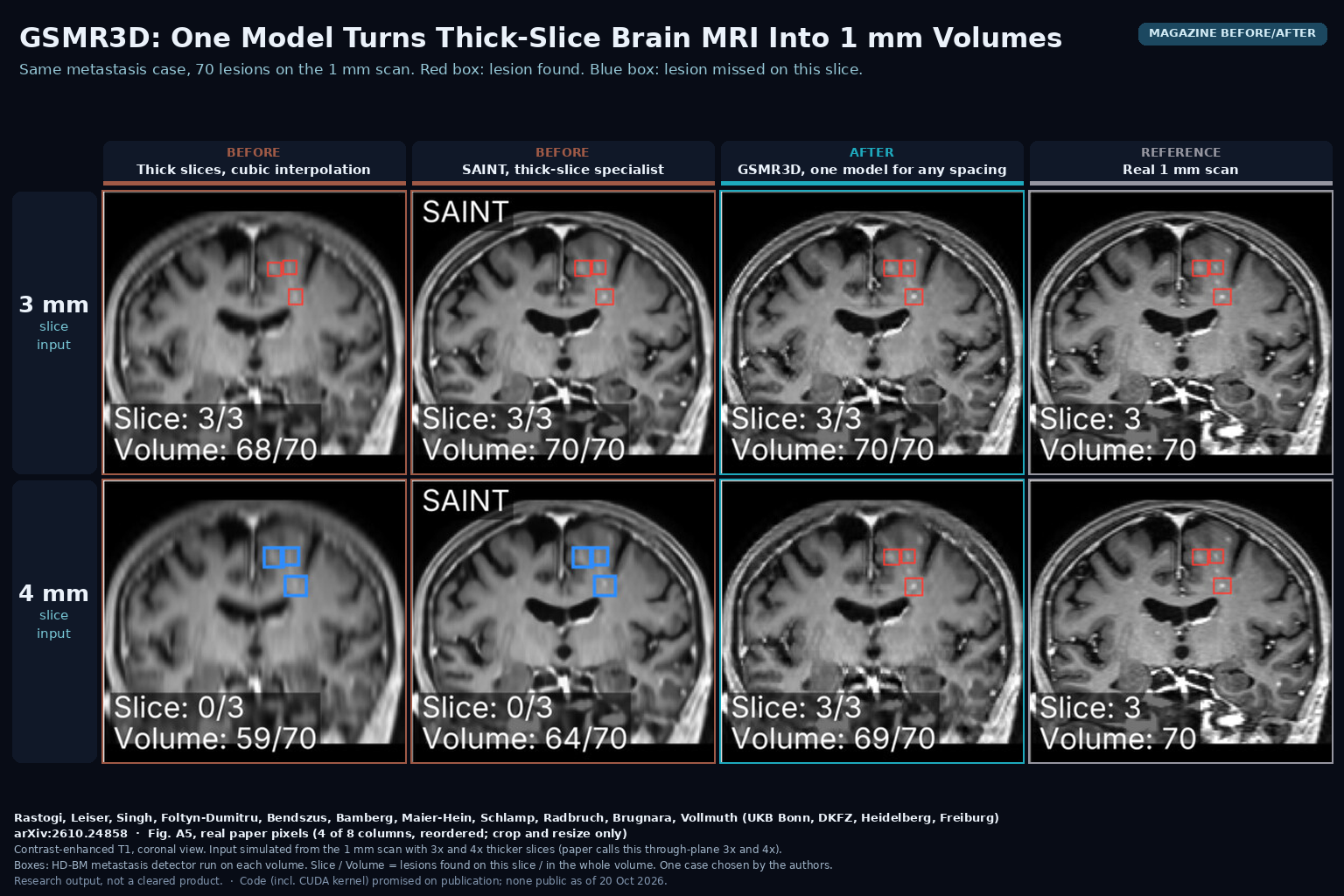 Magazine before/after from Fig. A5: coronal contrast-enhanced T1 of one brain-metastasis case rebuilt from 3 mm and 4 mm slices by cubic interpolation, SAINT and GSMR3D next to the real 1 mm scan, with detected (red) and missed (blue) lesion boxes. Rastogi, Leiser, ..., Brugnara, Vollmuth, arXiv:2610.24858