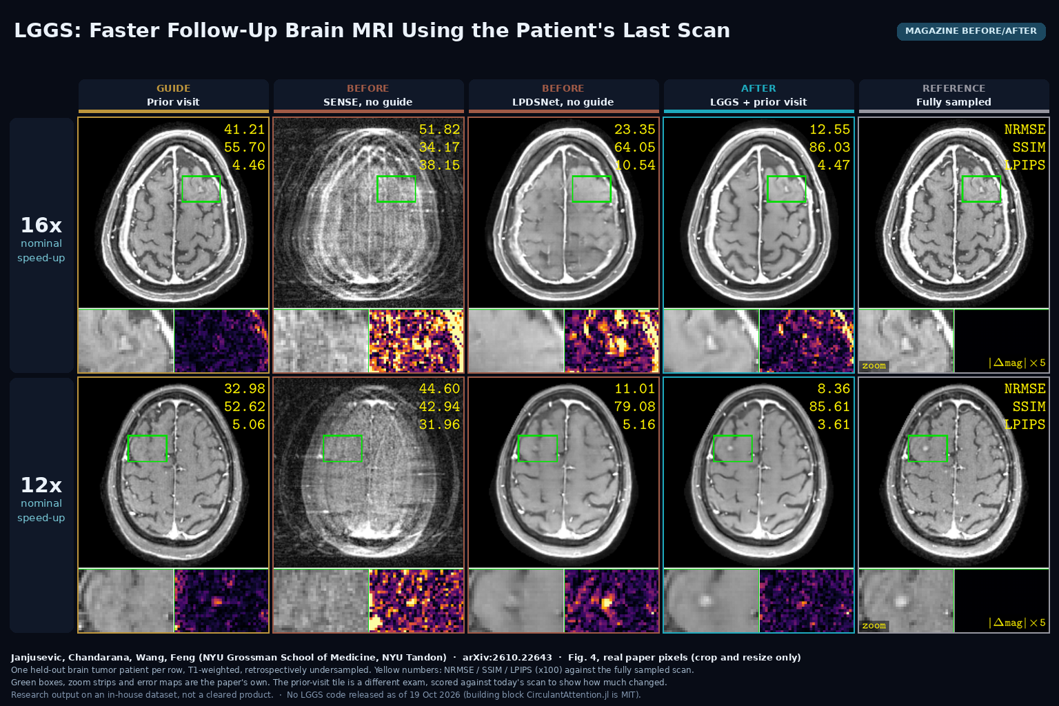Magazine before/after from Fig. 4: two held-out brain tumor patients at 16x and 12x acceleration, each shown as the prior visit used as guide, SENSE, unguided LPDSNet, LGGS and the fully sampled scan, with zoom and error strips. Janjusevic, Chandarana, Wang, Feng, arXiv:2610.22643