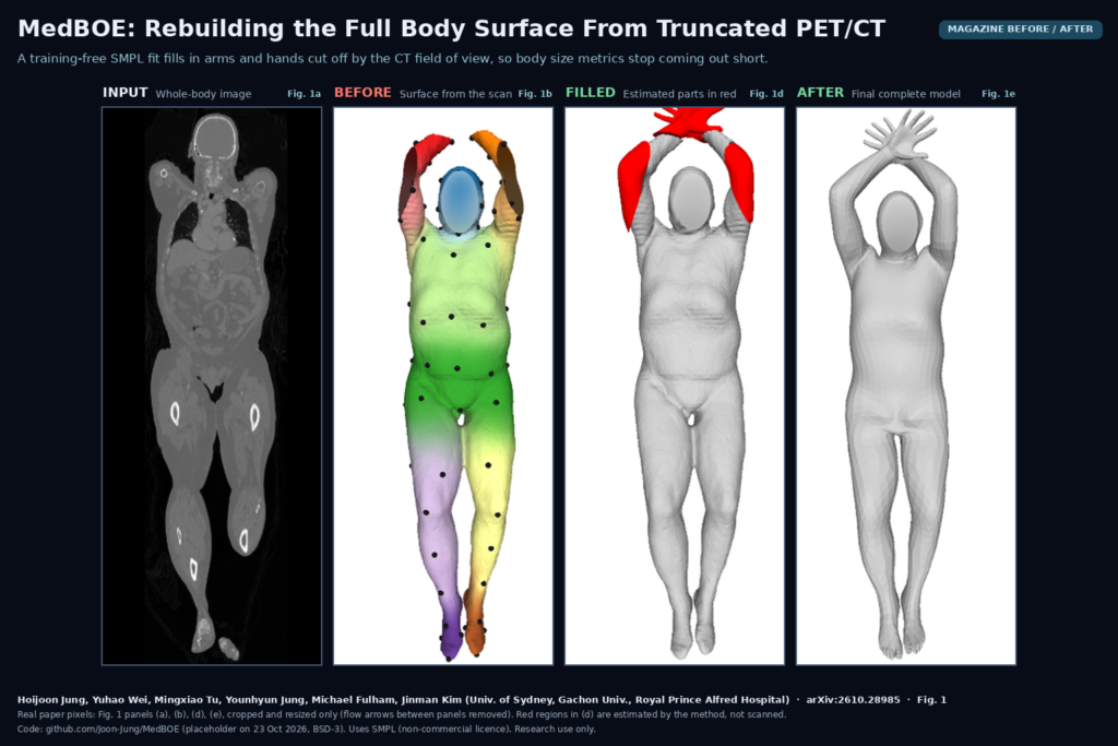 Four panels from Fig. 1 of the MedBOE paper: a coronal whole-body image, the incomplete body surface extracted from the scan with virtual-marker colours, the initial complete model with estimated arms and hands in red, and the final complete grey body model. Hoijoon Jung, Yuhao Wei and colleagues, University of Sydney, arXiv:2610.28985