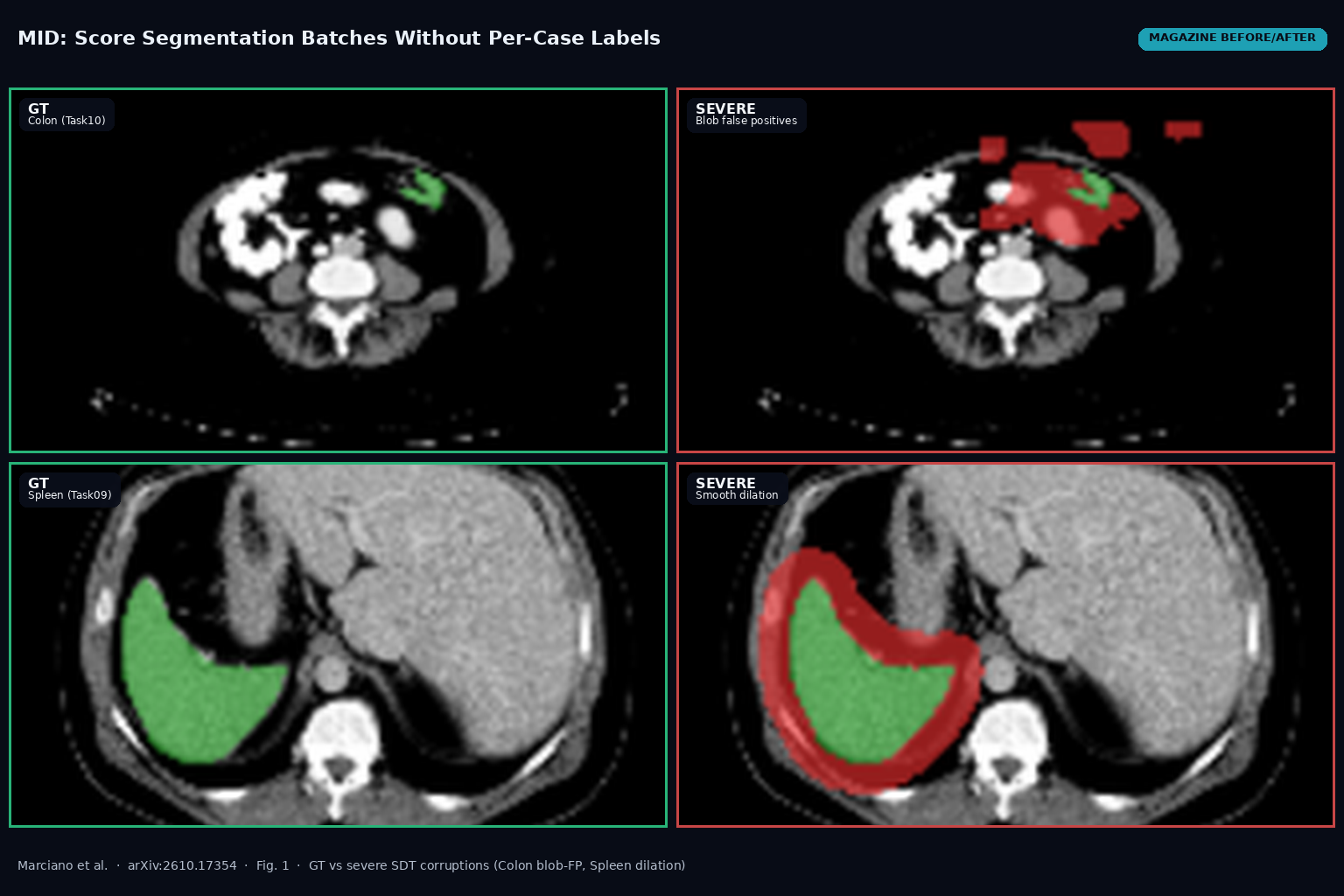 Magazine before/after from Fig. 1: Task10 Colon ground truth versus severe blob false positives (top); Task09 Spleen ground truth versus severe smooth dilation (bottom). Marcianò et al., arXiv:2610.17354