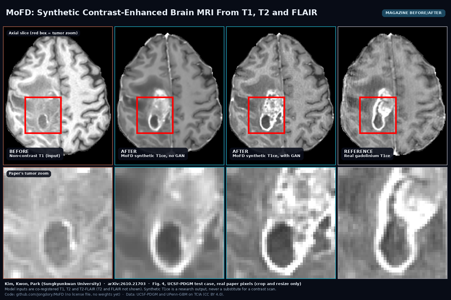 Magazine before/after from Fig. 4: a glioma case shown as the non-contrast T1 input, the MoFD synthetic T1ce without and with GAN loss, and the real gadolinium T1ce, with zoomed tumour views below. Kim, Kwon, Park, arXiv:2610.21703