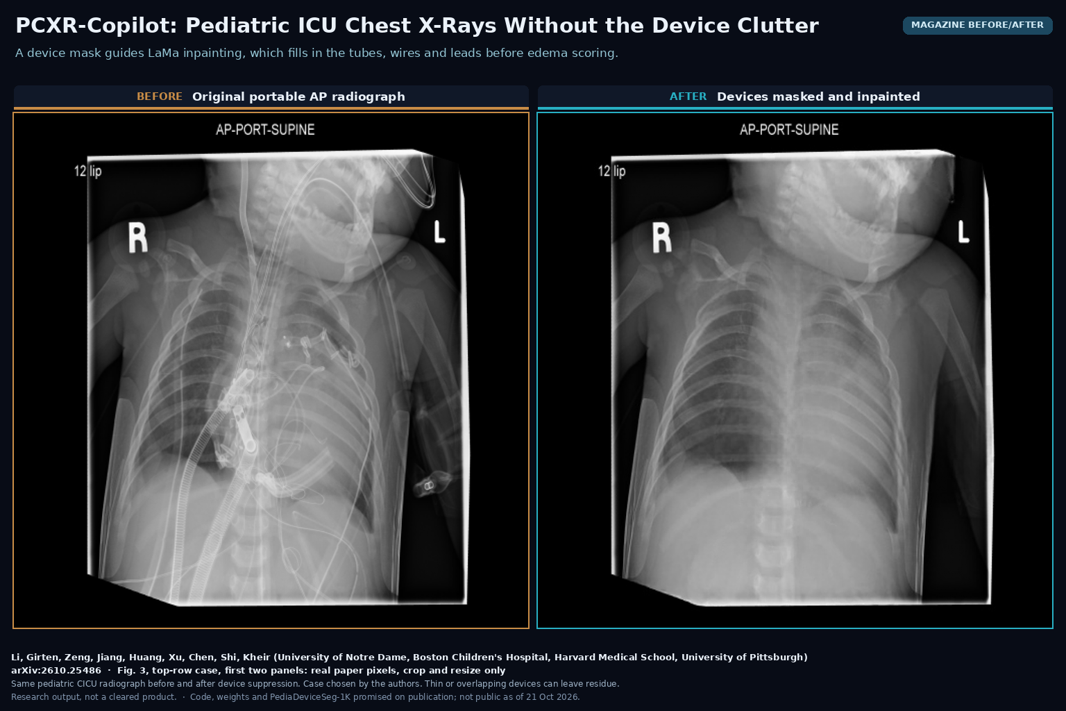 Magazine before/after from Fig. 3: the same portable AP chest radiograph of a child in a cardiac ICU, on the left with sternal wires, tubes, lines and ECG leads, on the right after PCXR-Copilot masked the devices and filled them in with LaMa inpainting. Li, Girten, Zeng, Jiang, Huang, Xu, Chen, Shi, Kheir, arXiv:2610.25486