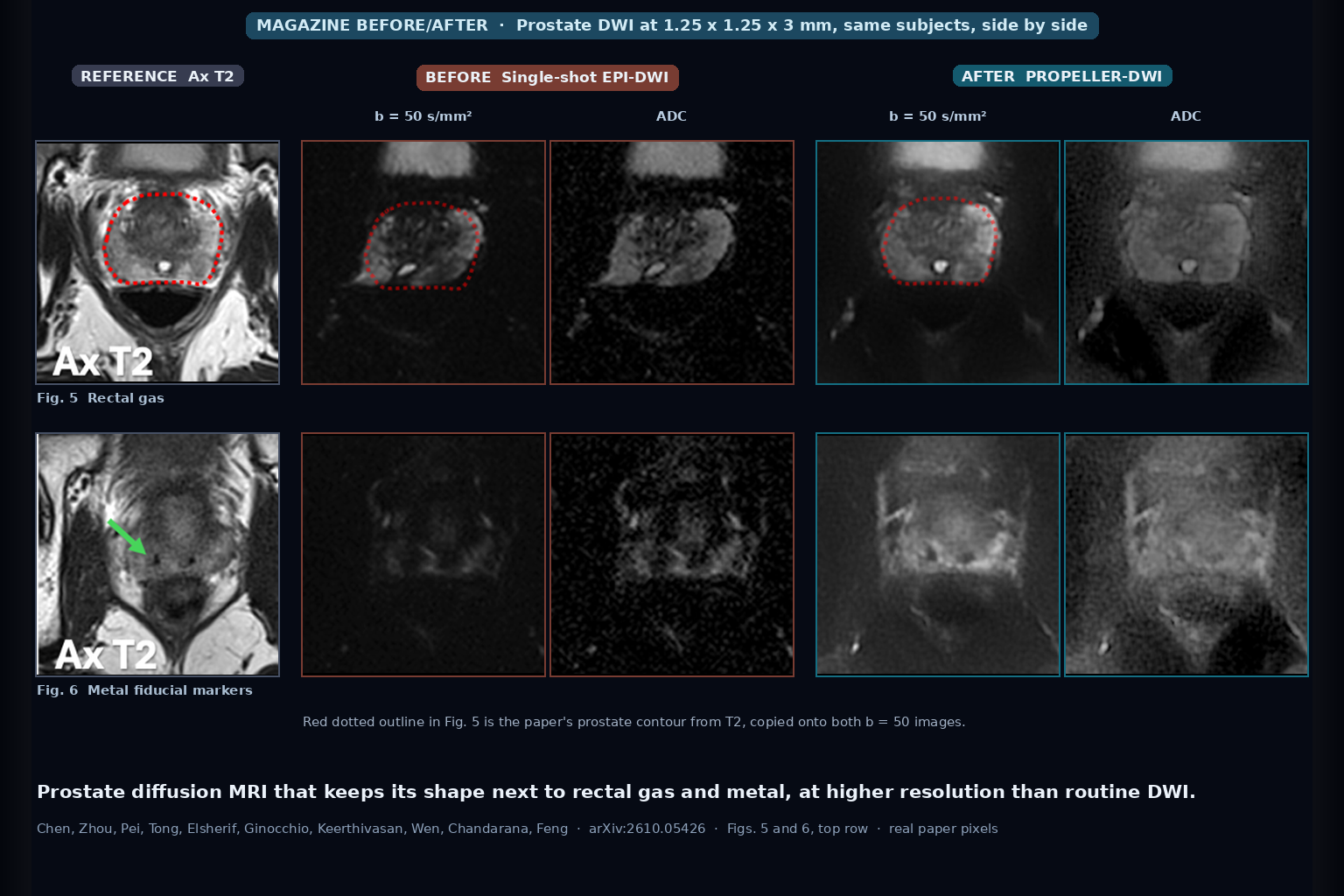 Axial T2 reference beside single-shot EPI-DWI and PROPELLER-DWI b=50 images and ADC maps at 1.25 mm for a prostate with rectal gas and one with metal fiducial markers. EPI warps or loses the gland, PROPELLER keeps its shape (Chen, Zhou, Pei, Tong, Elsherif, Ginocchio, Keerthivasan, Wen, Chandarana, Feng, arXiv:2610.05426, Figs. 5 and 6)