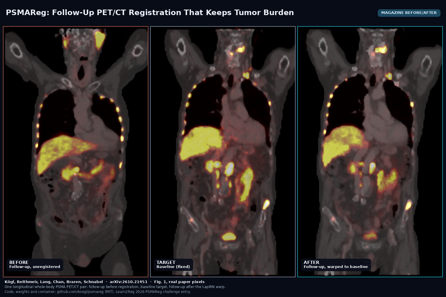 Magazine before/after from Fig. 1: coronal whole-body PSMA PET/CT of one pair, follow-up unregistered, baseline fixed, and follow-up warped by the LapIRN pipeline. Koegl et al., arXiv:2610.21451