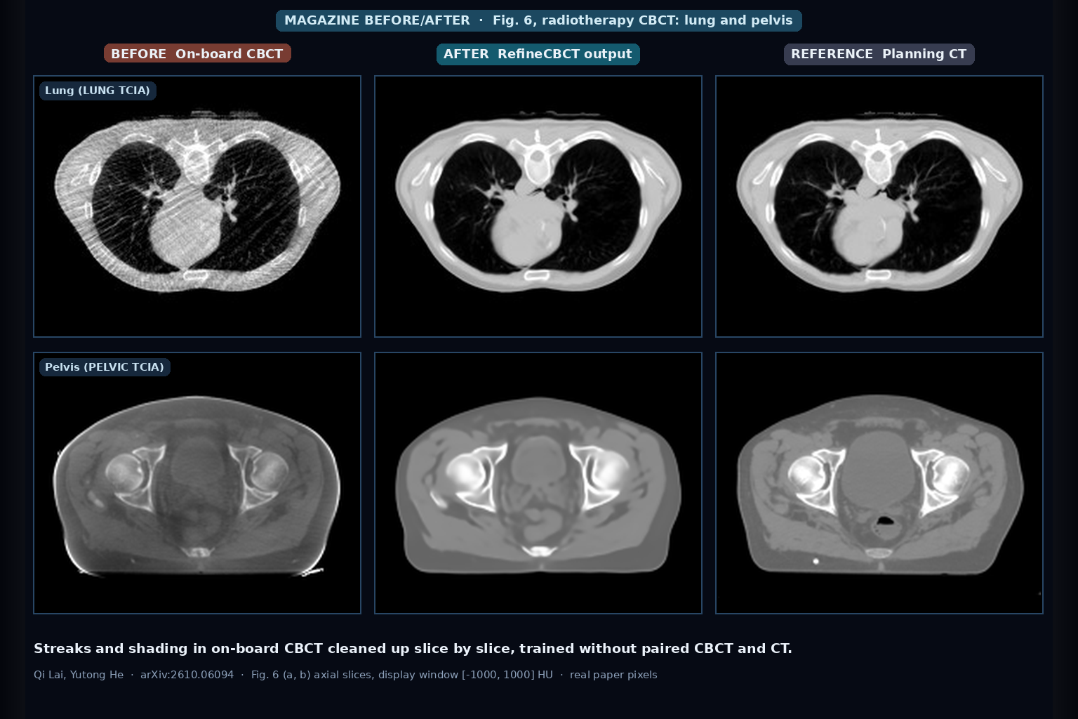 Axial lung and pelvic slices: original CBCT with streaks and shading, RefineCBCT output, and planning CT reference (Lai and He, arXiv:2610.06094, Fig. 6)
