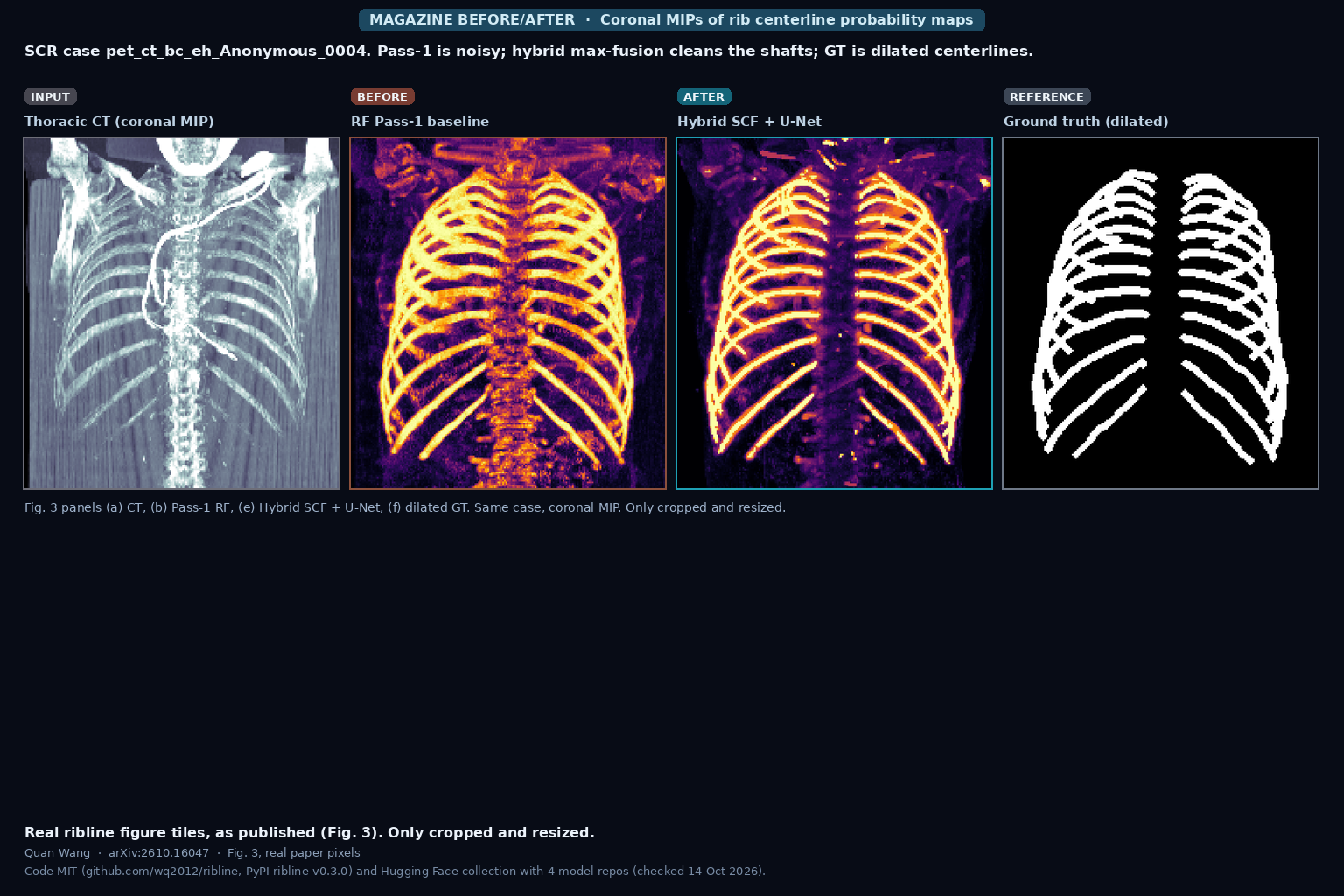 Coronal MIPs of SCR case pet_ct_bc_eh_Anonymous_0004 showing thoracic CT, Pass-1 random-forest probability map, hybrid SCF plus U-Net fusion, and dilated ground-truth rib centerlines (Quan Wang, arXiv:2610.16047, Fig. 3 panels a, b, e, f)