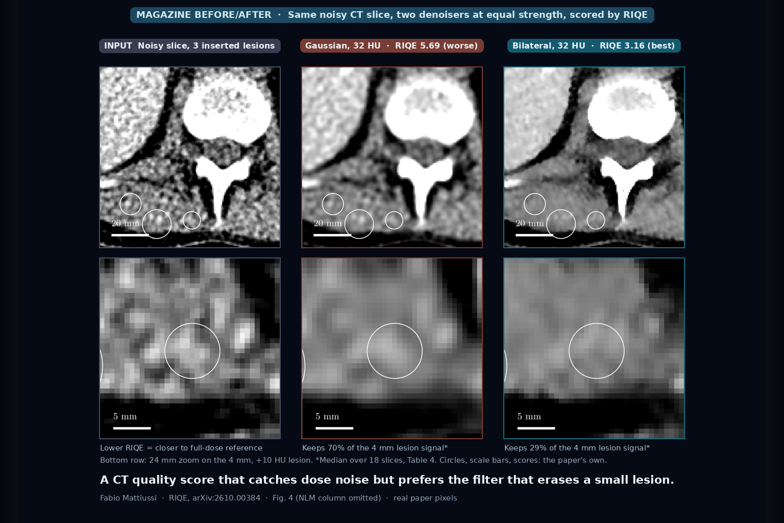 Abdominal CT slice with noise and three inserted lesions in circles, shown unfiltered, after Gaussian smoothing scored worse by RIQE, and after bilateral filtering scored best by RIQE while the 4 mm lesion fades (Mattiussi, arXiv:2610.00384, Fig. 4)