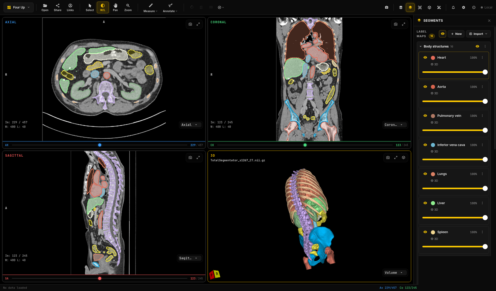 Segments panel listing 16 label maps for a chest, abdomen and pelvis CT, including heart, aorta, pulmonary vein, inferior vena cava, lungs, liver, spleen and kidneys, each with a visibility toggle and opacity slider, next to the slice and 3D views
