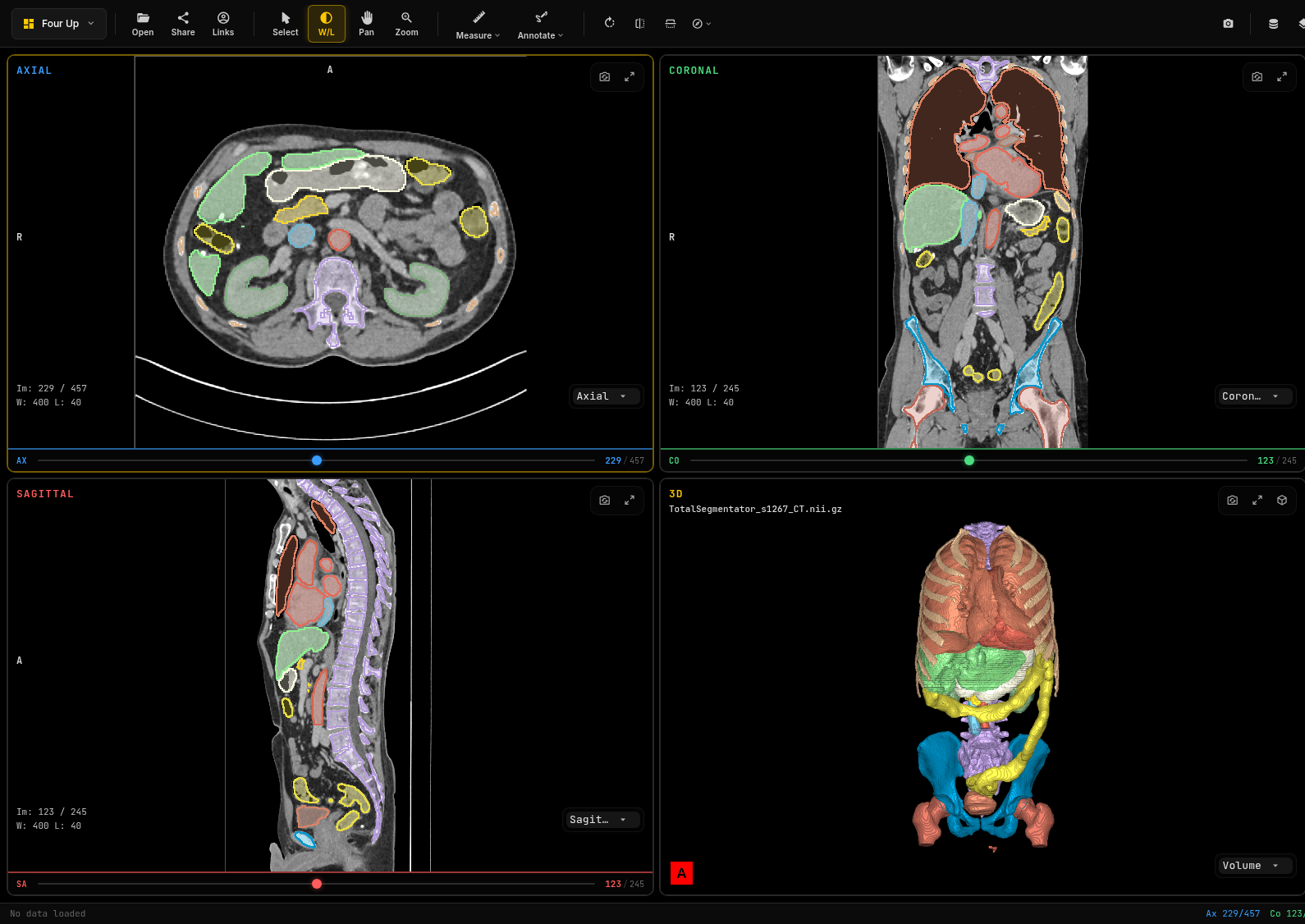 Four-up view of a chest, abdomen and pelvis CT with colored label-map outlines on the axial, coronal and sagittal slices and a 3D surface model of the segmented structures
