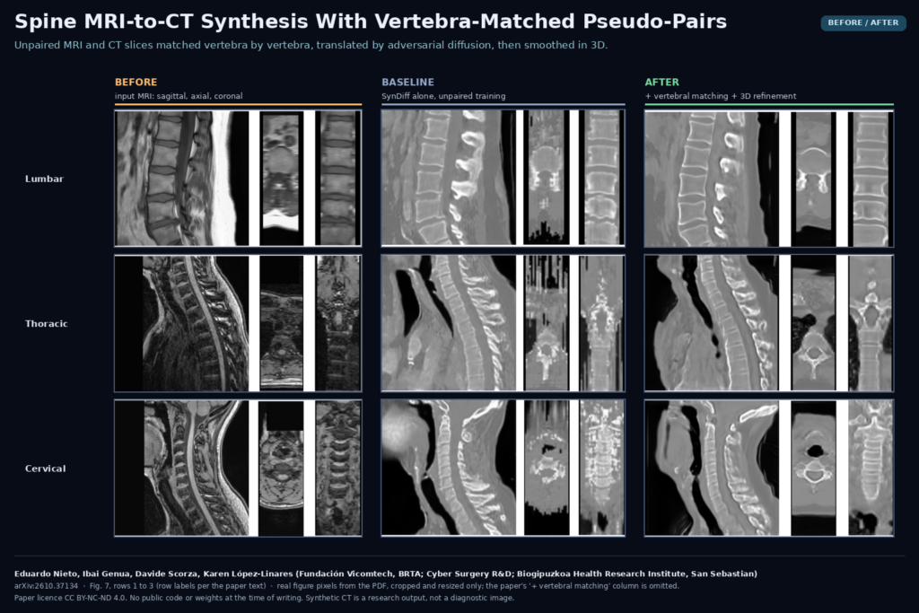 Figure 7 of arXiv:2610.37134 by Eduardo Nieto, Ibai Genua, Davide Scorza and Karen Lopez-Linares (Vicomtech, Cyber Surgery, Biogipuzkoa): lumbar, thoracic and cervical spine MRI in sagittal, axial and coronal views, the synthetic CT from the SynDiff baseline, and the synthetic CT from the full pipeline with vertebral matching and 3D refinement.