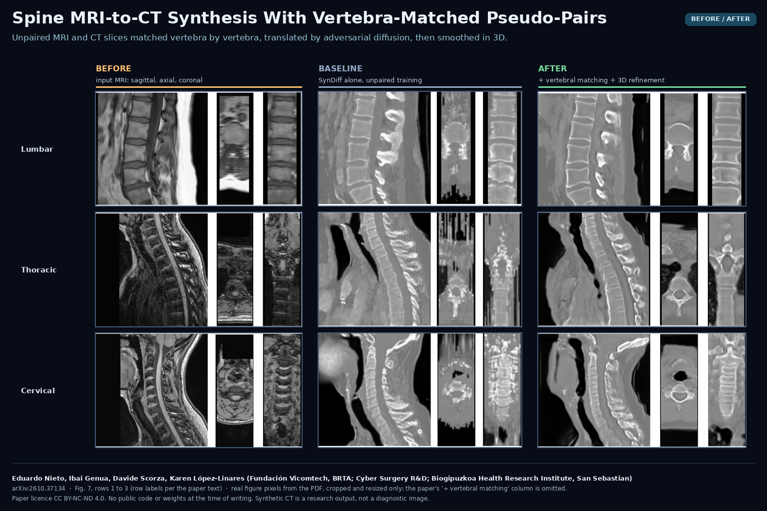 Figure 7 of arXiv:2610.37134 by Eduardo Nieto, Ibai Genua, Davide Scorza and Karen Lopez-Linares (Vicomtech, Cyber Surgery, Biogipuzkoa): lumbar, thoracic and cervical spine MRI in sagittal, axial and coronal views, the synthetic CT from the SynDiff baseline, and the synthetic CT from the full pipeline with vertebral matching and 3D refinement.