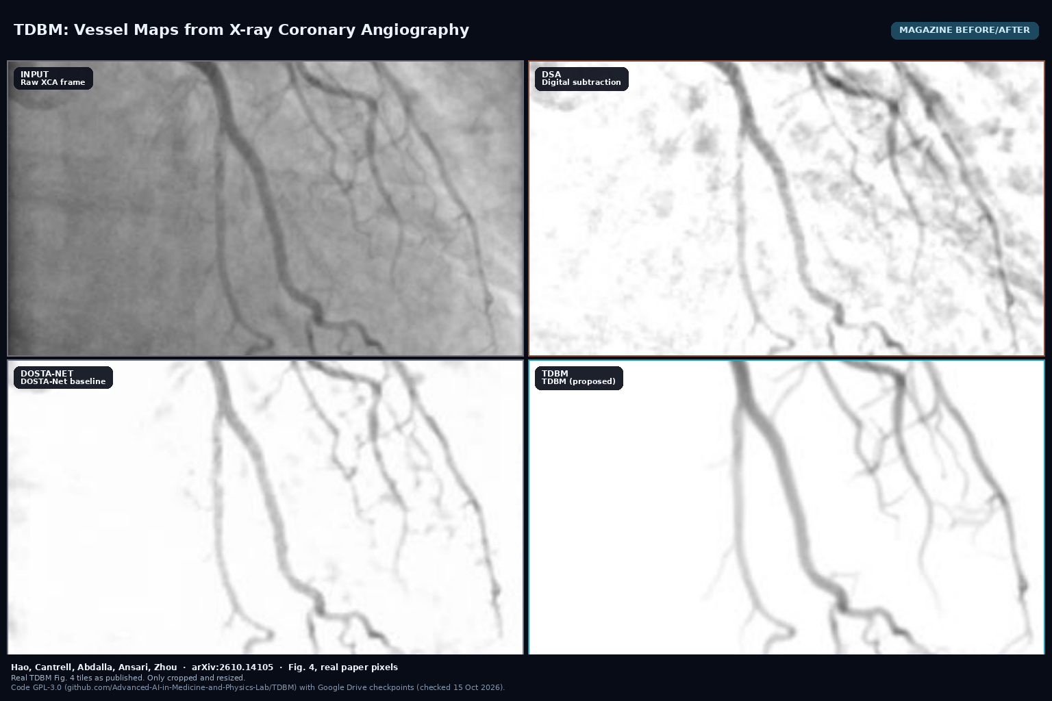 Four panels from Fig. 4: raw XCA input, DSA, DOSTA-Net, and TDBM vessel map on the same internal coronary angiography frame (Hao et al., arXiv:2610.14105)