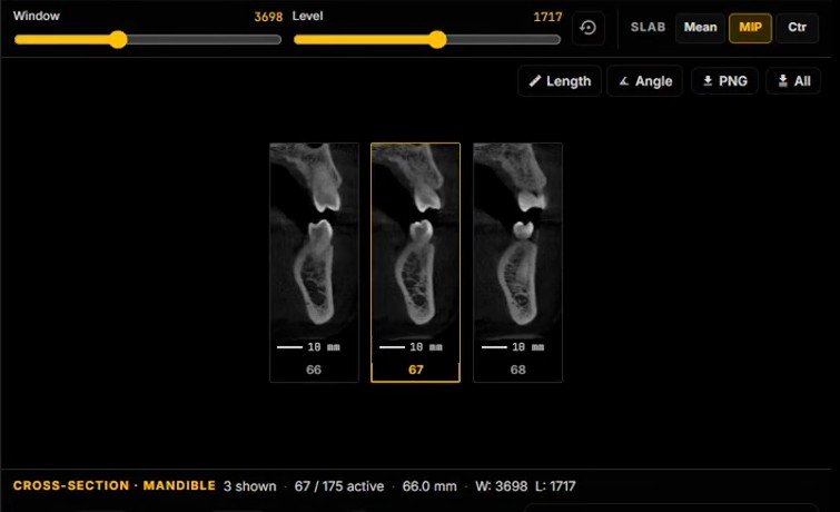 Three CBCT cross-sections of the mandible numbered 66, 67 and 68, each with a 10 mm scale bar, under window and level sliders and Length, Angle and PNG export buttons