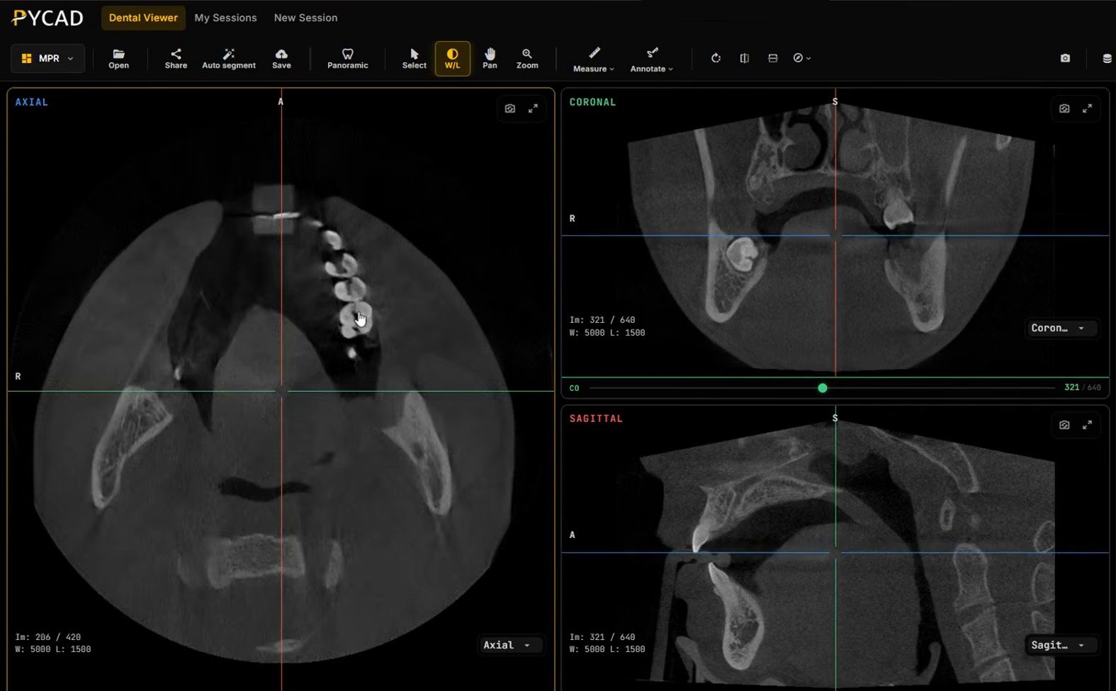 Dental CBCT in three linked views: axial on the left, coronal and sagittal on the right, with crosshairs and window/level readouts, under a toolbar with Open, Share, Auto segment, Save, Panoramic, W/L, Measure and Annotate buttons